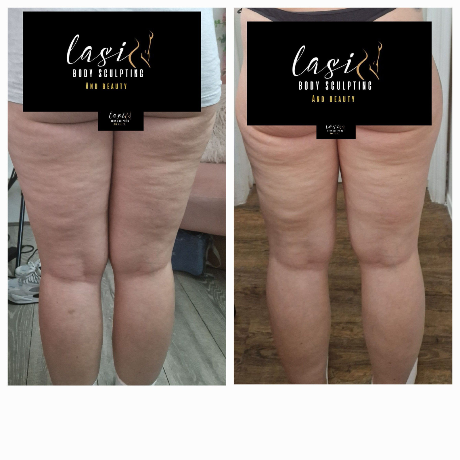 before and after fat dissolving injection images